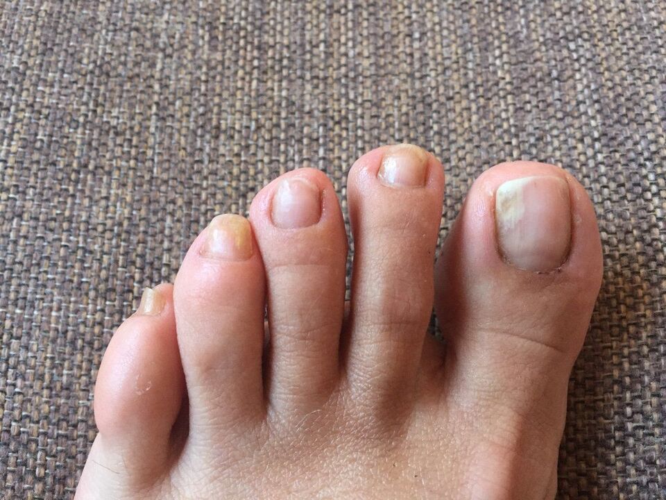 causas de los hongos en las uñas de los pies